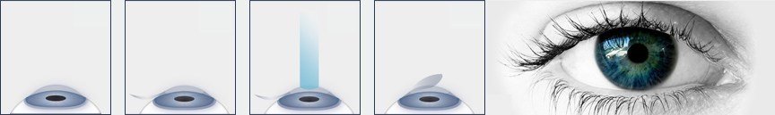 A four-step illustration of a corneal flap being lifted, treated with a beam and laid back, beside a photograph of an open eye.