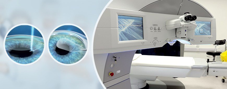 Two cross-section illustrations of a cornea beside a photograph of a laser surgery suite.