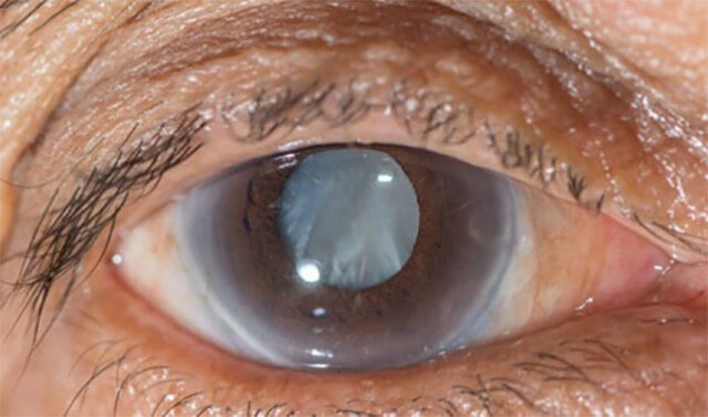 lens replacement surgery