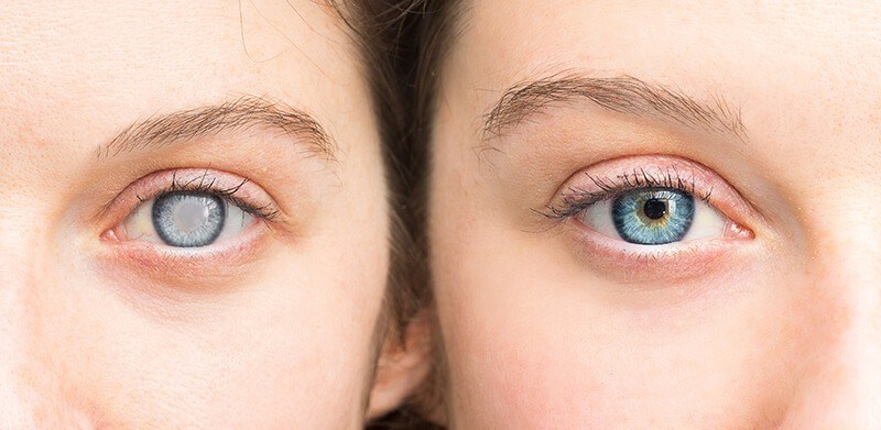 cataract before and after