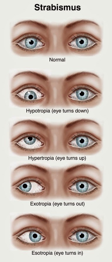 Strabismus