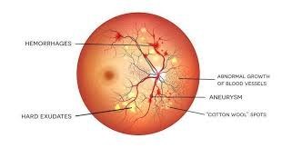 Am I at risk of having Diabetic retinopathy ? Am I at risk of having Diabetic retinopathy ?