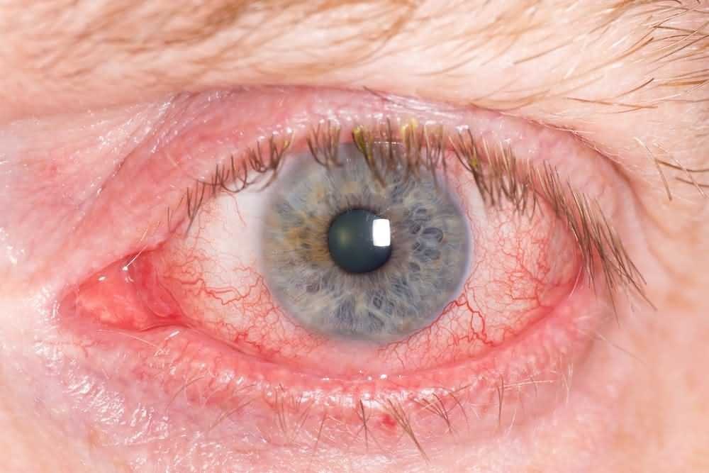 Close-up of an eye with a reddened white and prominent blood vessels.