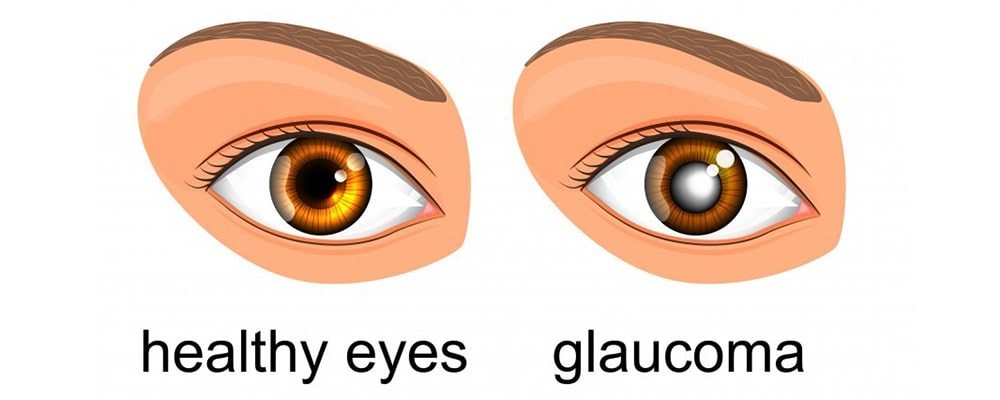 Symptoms of Glaucoma  