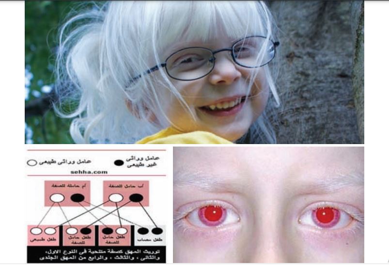 Albinism
