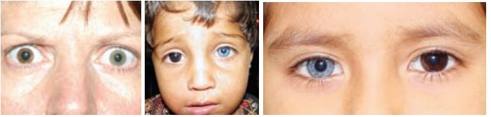 Heterochromia