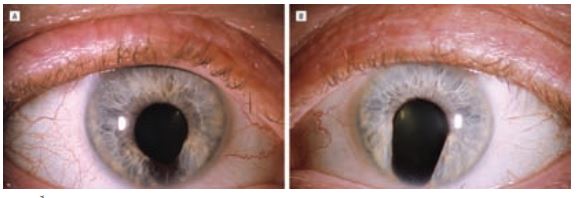 2- Coloboma of the iris 