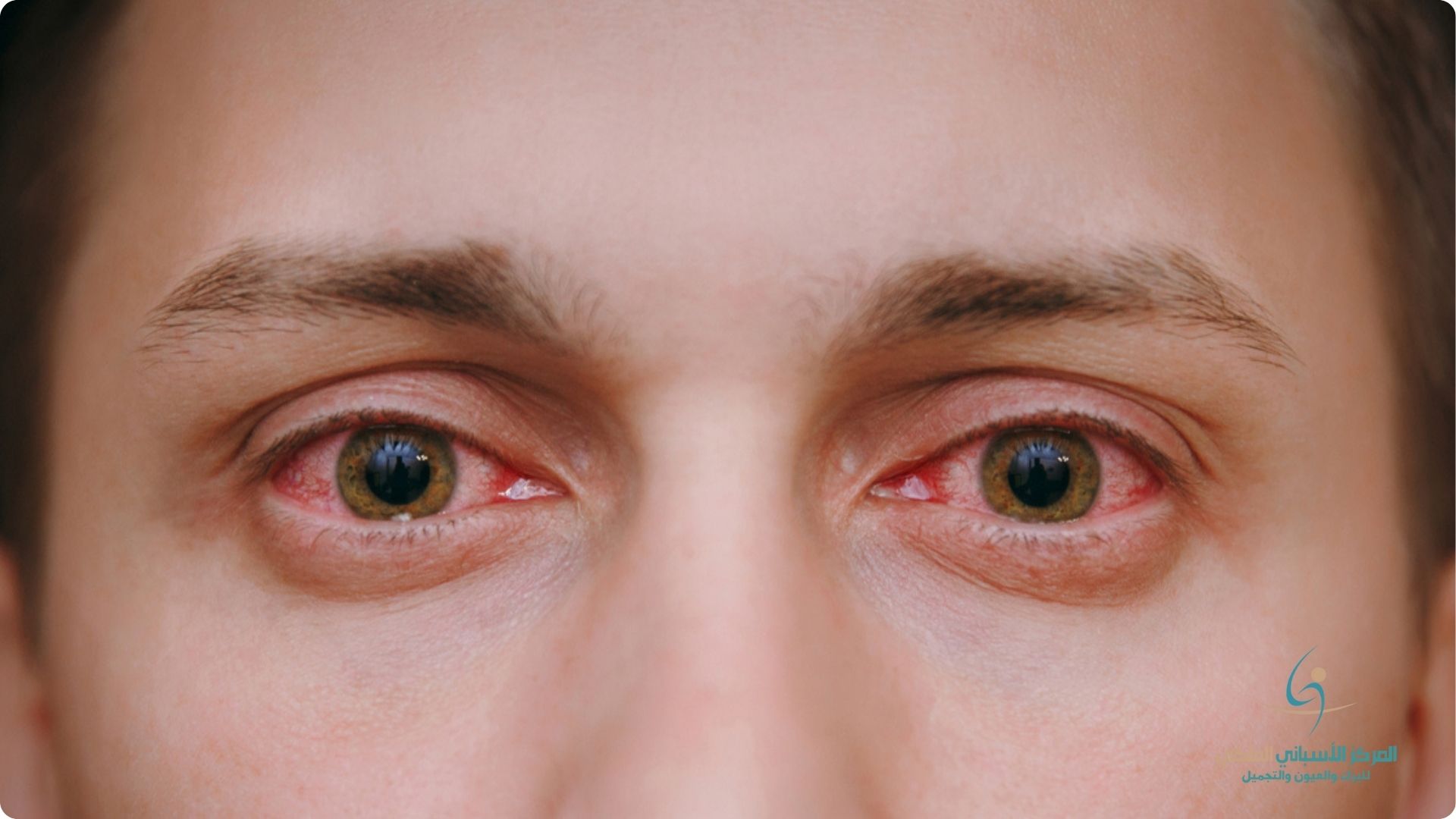 What is the cause of sudden redness in the whites of the eyes When is this considered an indication of a disease