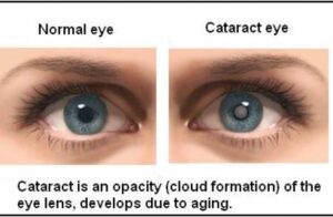 Cataract surgery