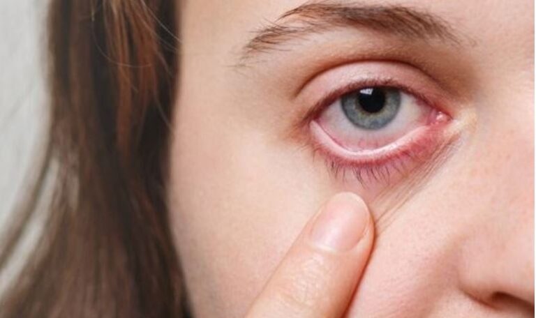 Eye Allergy Itchy Eyes Symptoms Causes And Home Remedies For Treatment Royal Spanish Center 